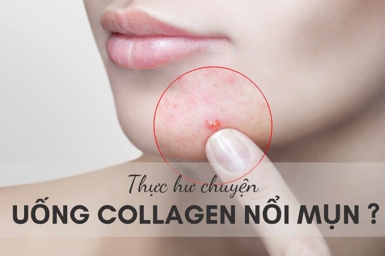 Giải đáp vấn đề băn khoăn của bạn đọc: Uống Collagen bị nổi mụn?