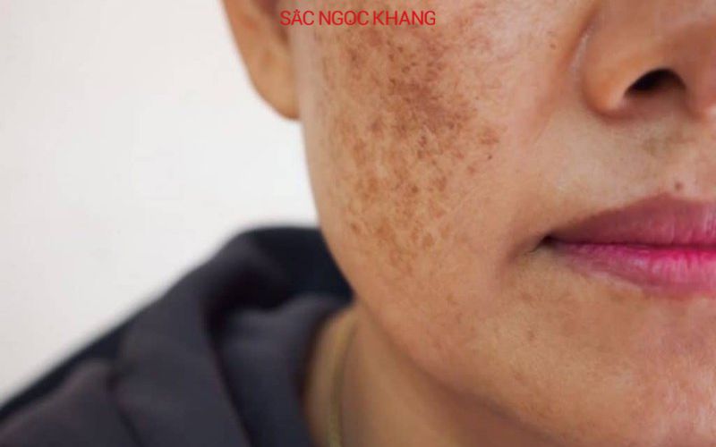 Nám da mặt là tình trạng tăng sinh quá mức sắc tố melanin trên da