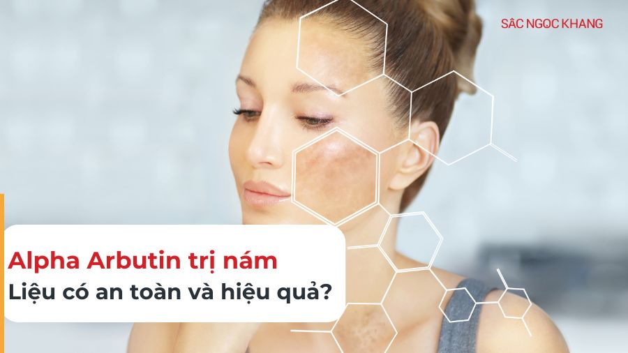Alpha Arbutin trị nám có an toàn không? Giải đáp chi tiết