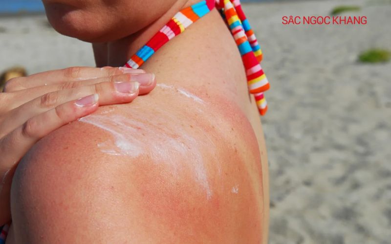 Tia UV có thể gây cháy nắng