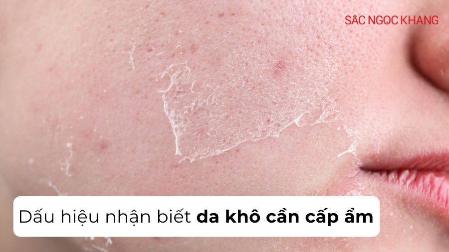Dấu hiệu làn da khô cần cấp ẩm - bạn đã biết chưa?