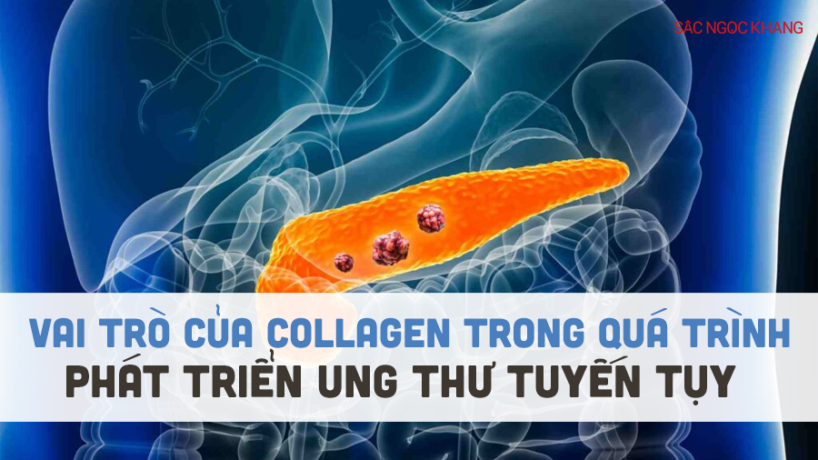 Vai trò của collagen trong quá trình phát triển ung thư tuyến tụy