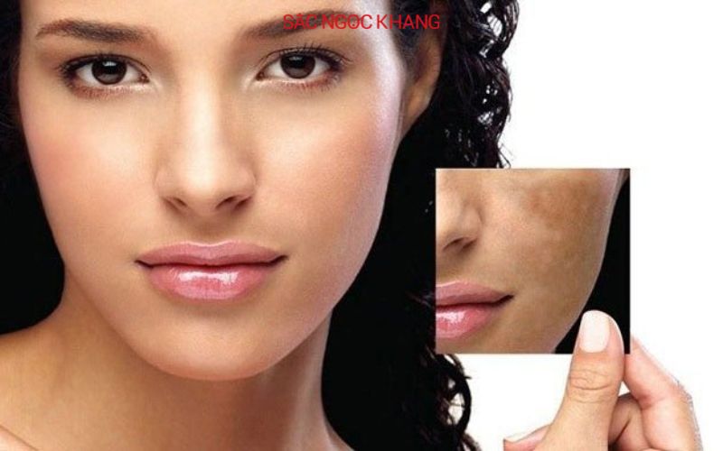 Da không đều màu là tình trạng da bị rối loạn sắc tố melanin