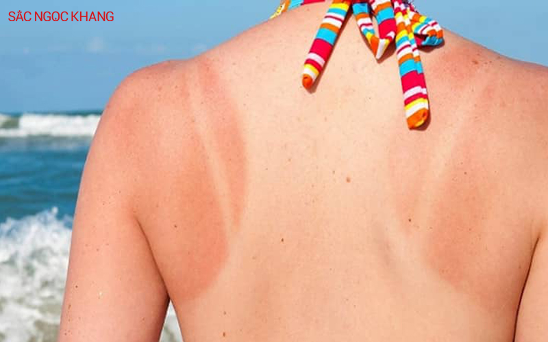 Da bị cháy nắng là tình trạng da bị tổn thương do tiếp xúc quá mức với tia UV