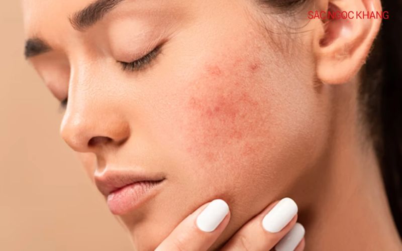 Da nhảy cảm dễ bị kích ứng, mẩn đỏ