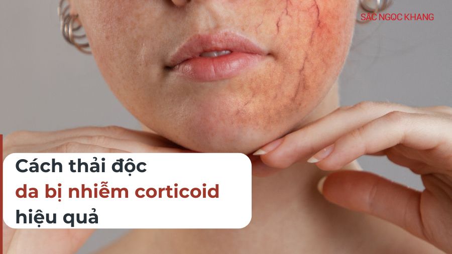 Bí quyết thải độc da nhiễm corticoid hiệu quả