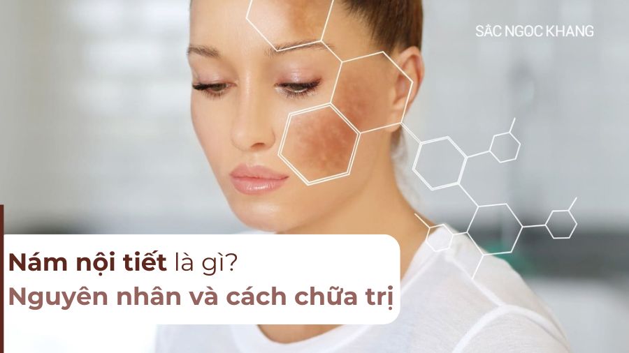 Nám nội tiết là gì? Nguyên nhân và cách chữa trị hiệu quả nhất