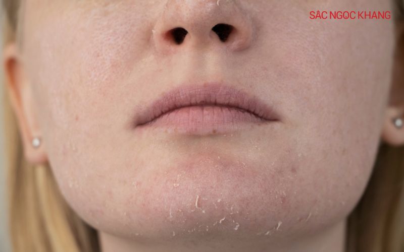 Xuất hiện vảy trắng, bong tróc