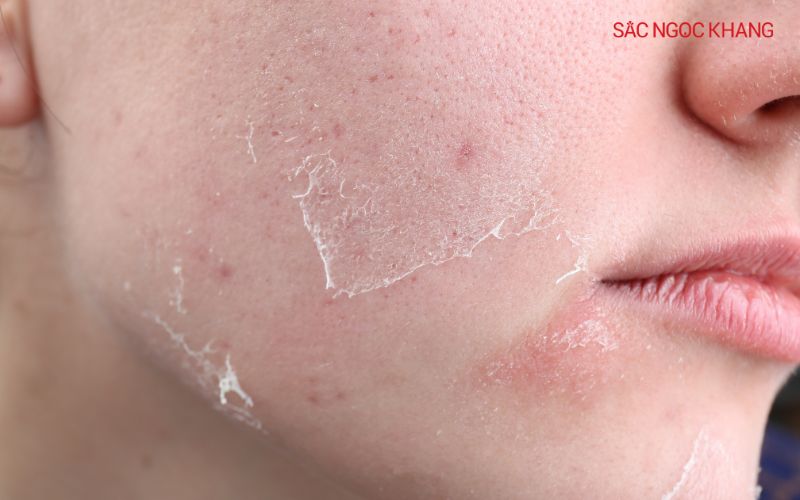 Da khô nên chọn sản phẩm chứa cả ba nhóm thành phần: hút ẩm, làm mềm và khóa ẩm