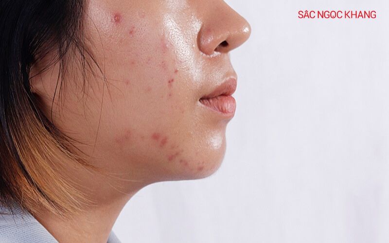 Da dầu luôn trong tình trạng nhờn rít và dễ nổi mụn