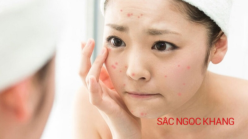 Giải pháp hạn chế tiết dầu mụn ẩn vào mùa nóng hiệu quả, an toàn