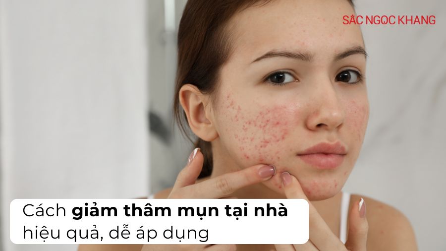 10 cách giảm thâm mụn tại nhà siêu hiệu quả, dễ áp dụng