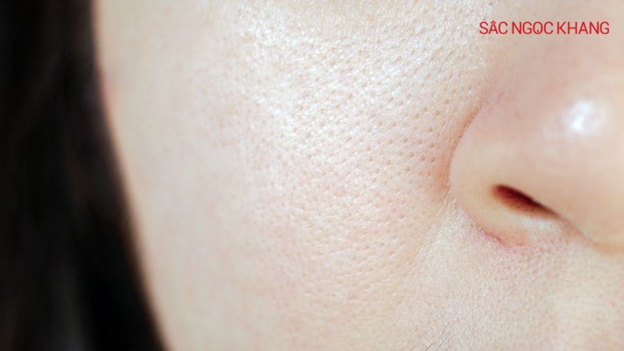 Tăng tiết bã nhờn là nguyên nhân hàng đầu gây lỗ chân lông to