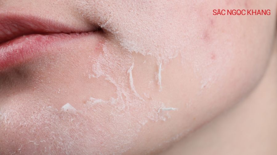 Peel da hóa học là một phương pháp sử dụng các chất hóa học để tẩy tế bào chết sâu