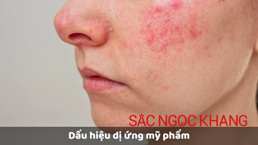 Dấu hiệu nhận biết da bị dị ứng mỹ phẩm