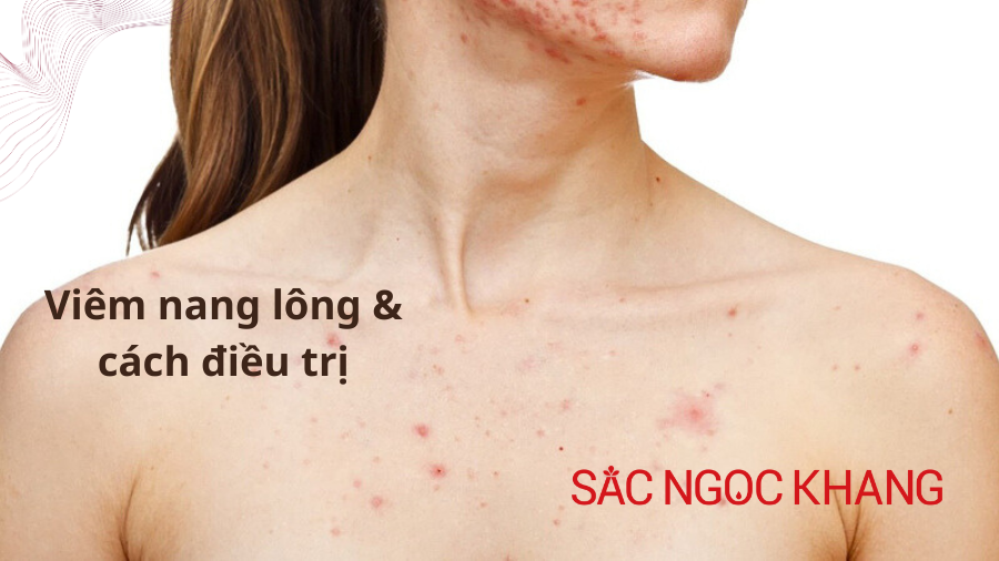 Viêm nang lông: triệu chứng nguyên nhân và cách điều trị