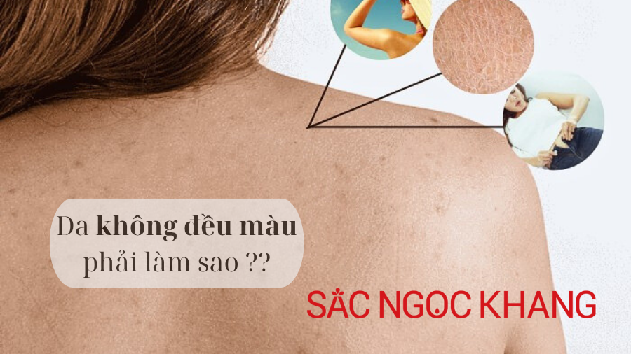 Da body không đều màu: Nguyên nhân & cách khắc phục hiệu quả