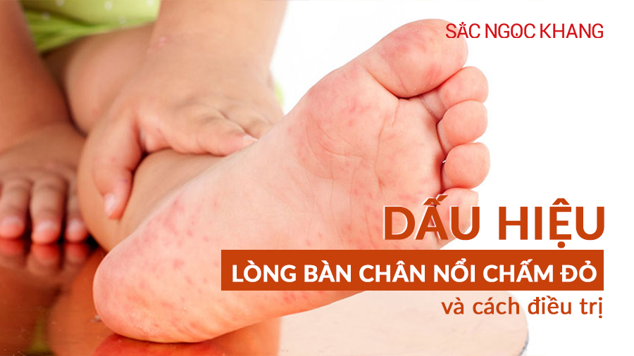 lòng bàn chân nổi chấm đỏ