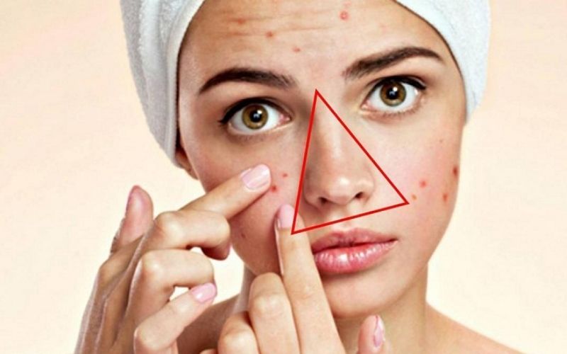 Nặn mụn đinh râu bị méo mồm
