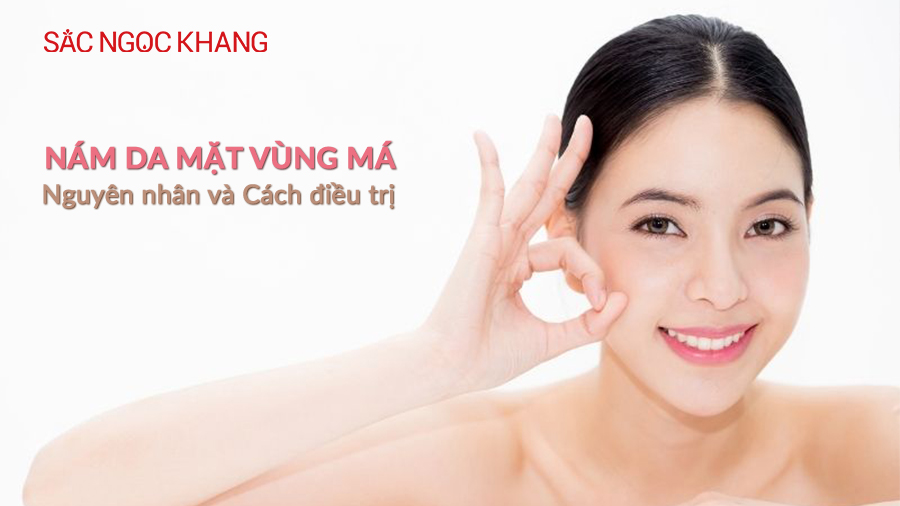 nám da mặt vùng má