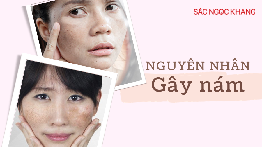 nguyên nhân gây nám