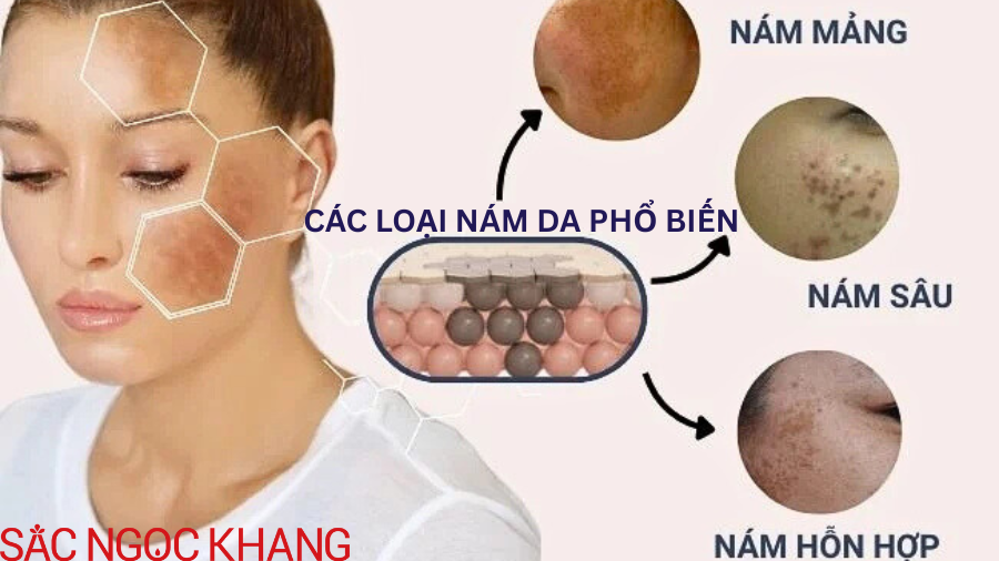 Các loại nám da phổ biến - nguyên nhân và cách điều trị