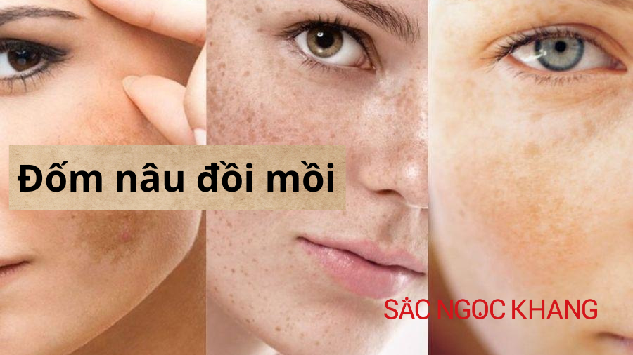 Đốm nâu đồi mồi – Dấu hiệu tuổi tác hay lời cảnh báo từ làn da?